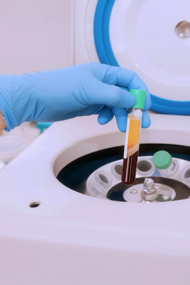 PRF (Platelet-Rich Fibrin)