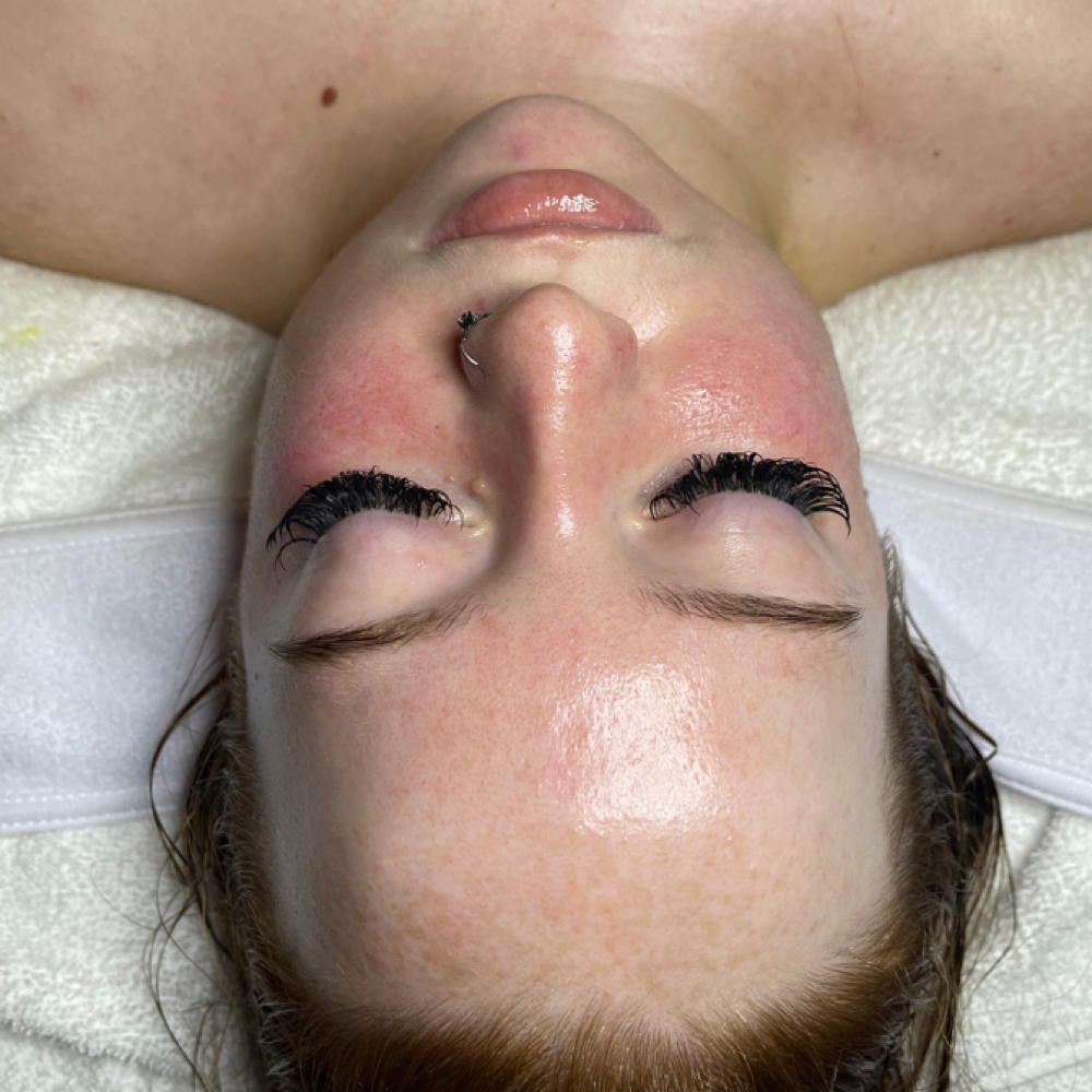 Glass Skyn Facial at Skyn Unveiled in Dallas, TX