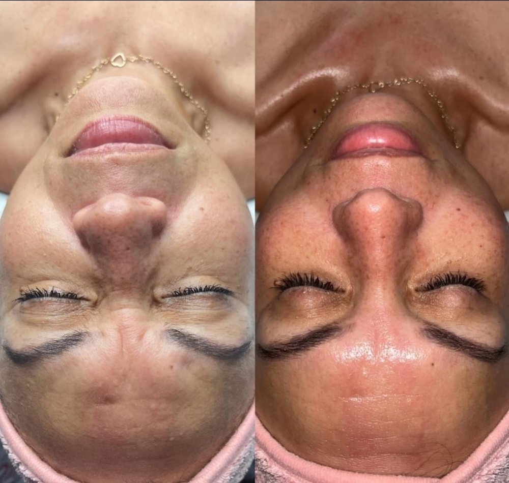 Lavish Dermaplane Facial DEAL