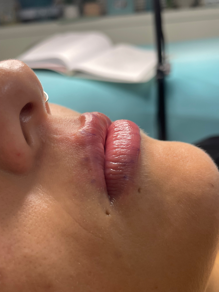 Needless Lip Filler 0.5ml