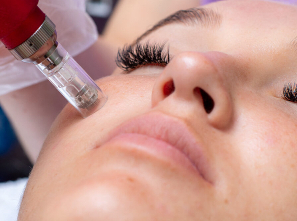 Microneedling