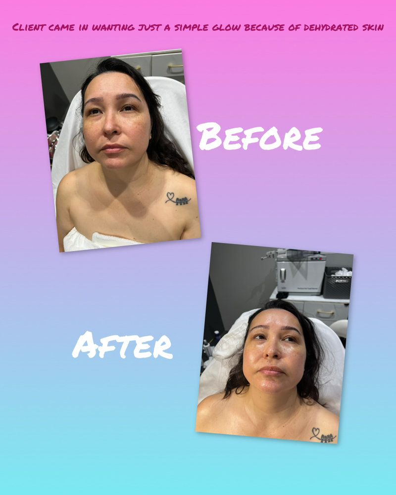 Microdermabrasion