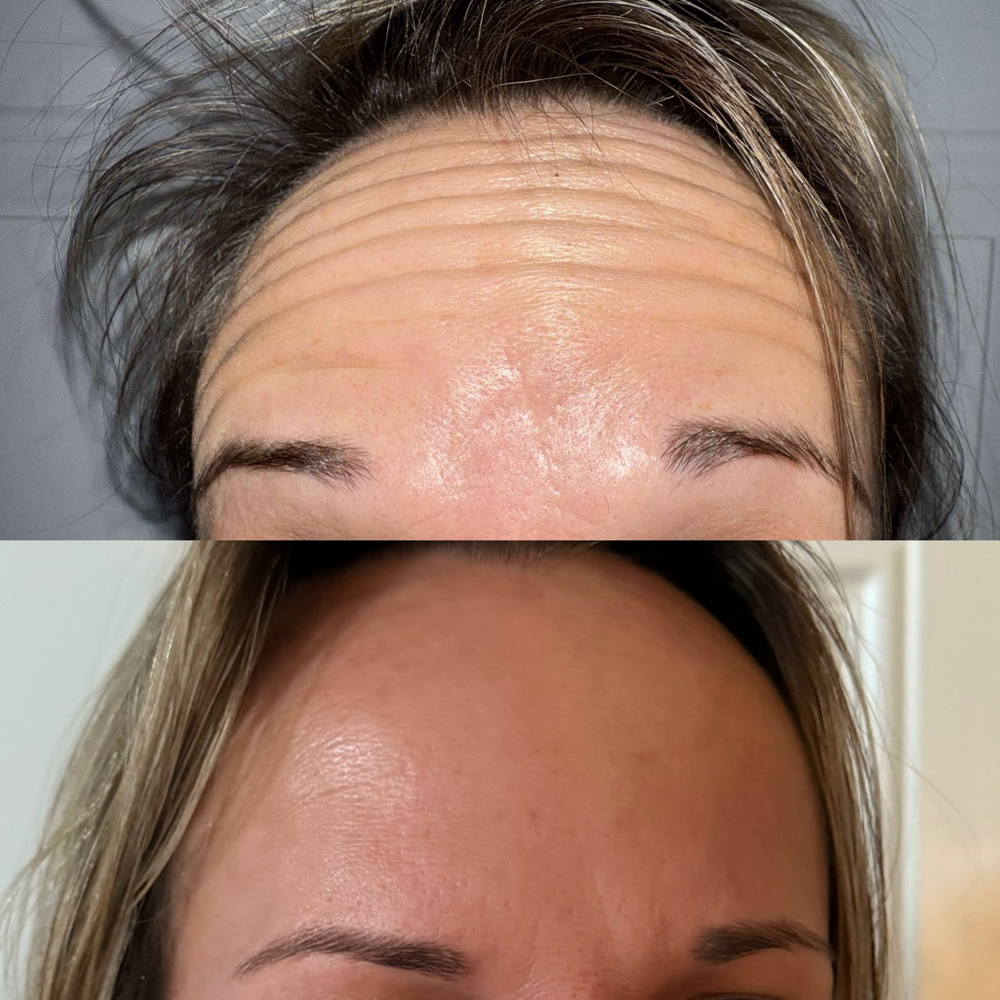Botox