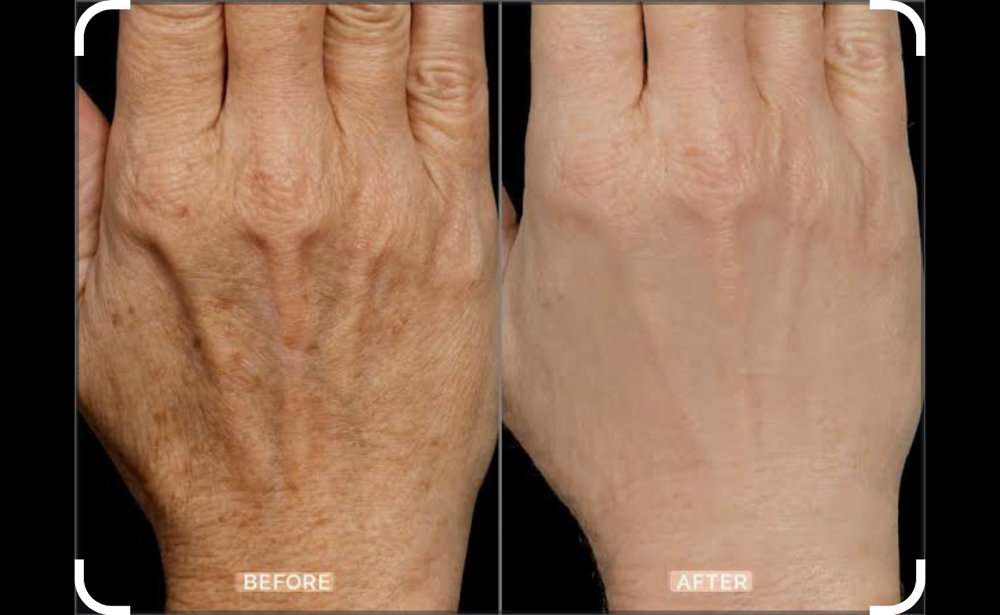 Hand Microchanneling