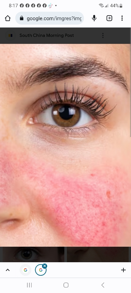 The Seattle “Rosacea + Eczema”