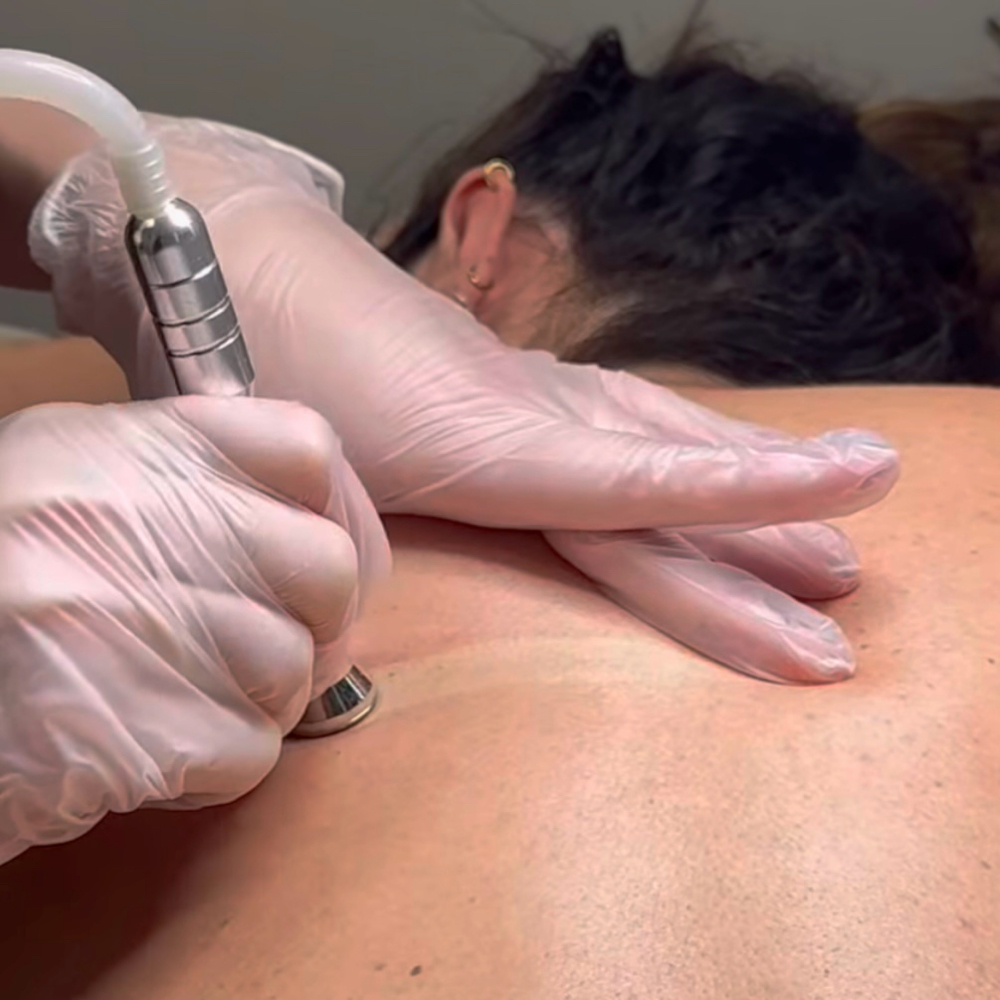 Microdermabrasion Back Treatment