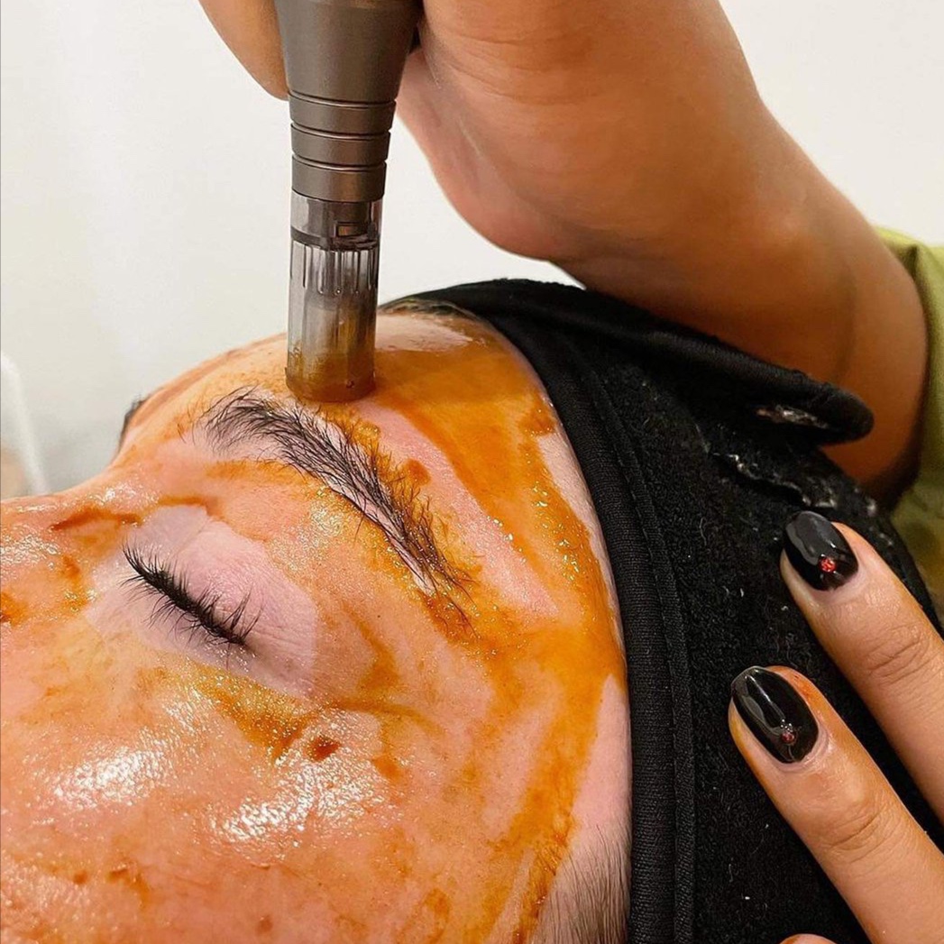 Exosome Facial Infusion at SoLuna Aesthetics in Scottsdale, AZ