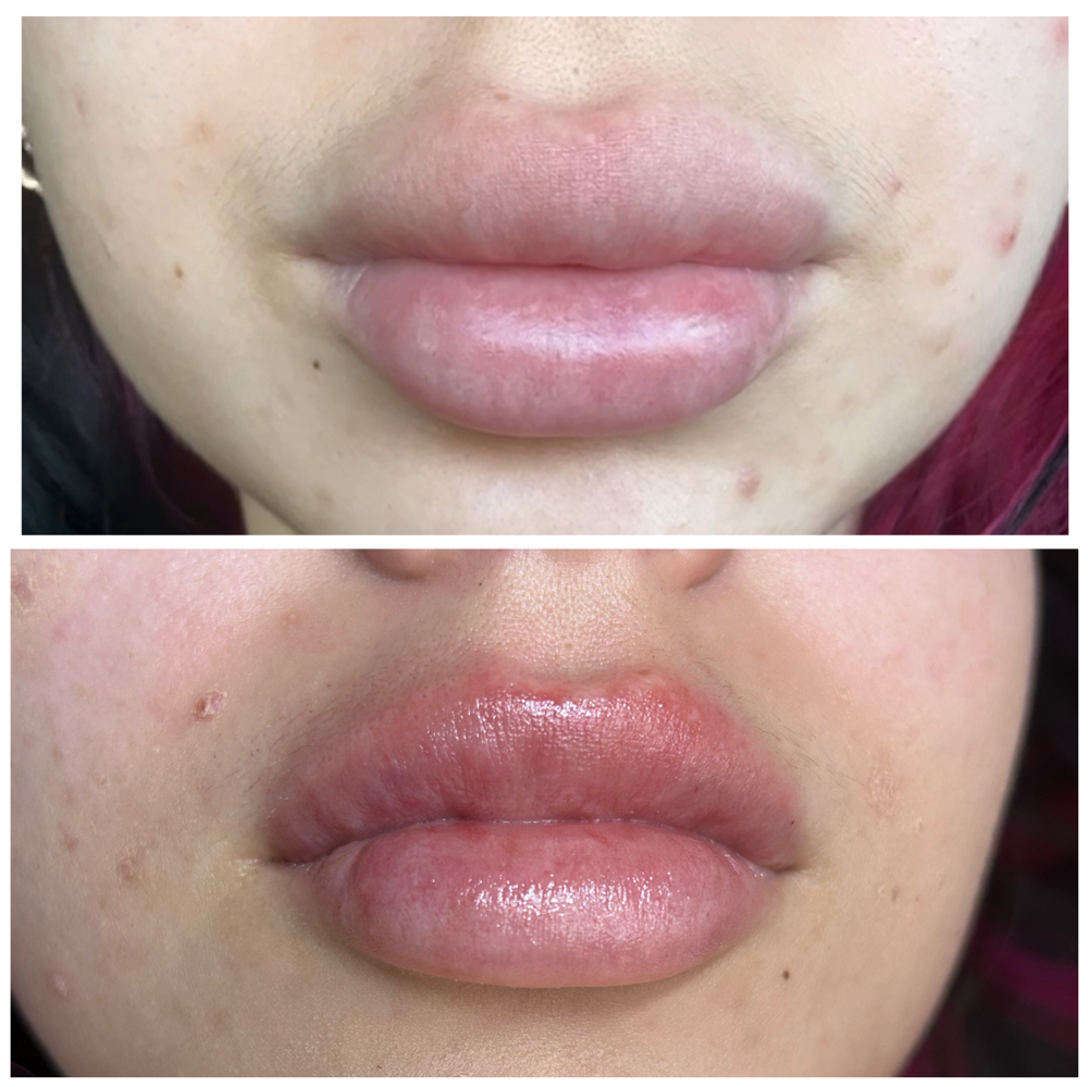 Lip Dissolver (Filler Removal)