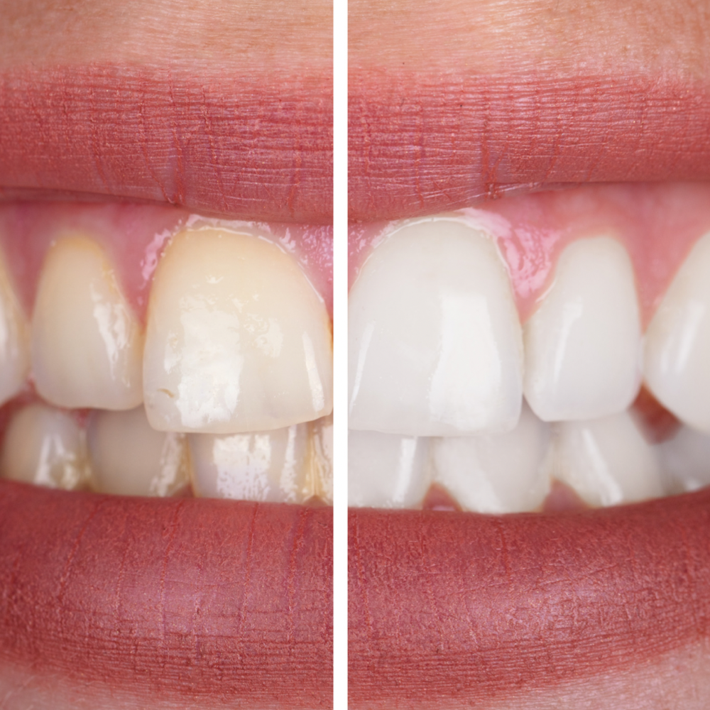 60 Min Teeth Whitening