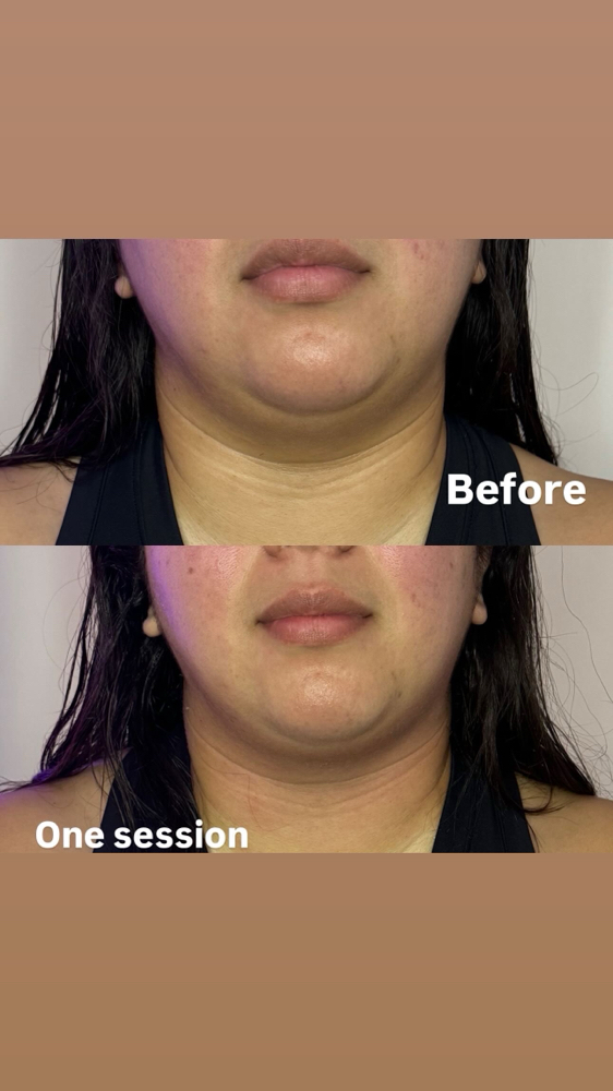 Jawline Contouring