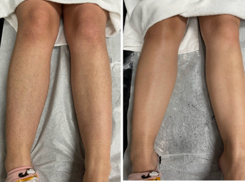 Lower Leg