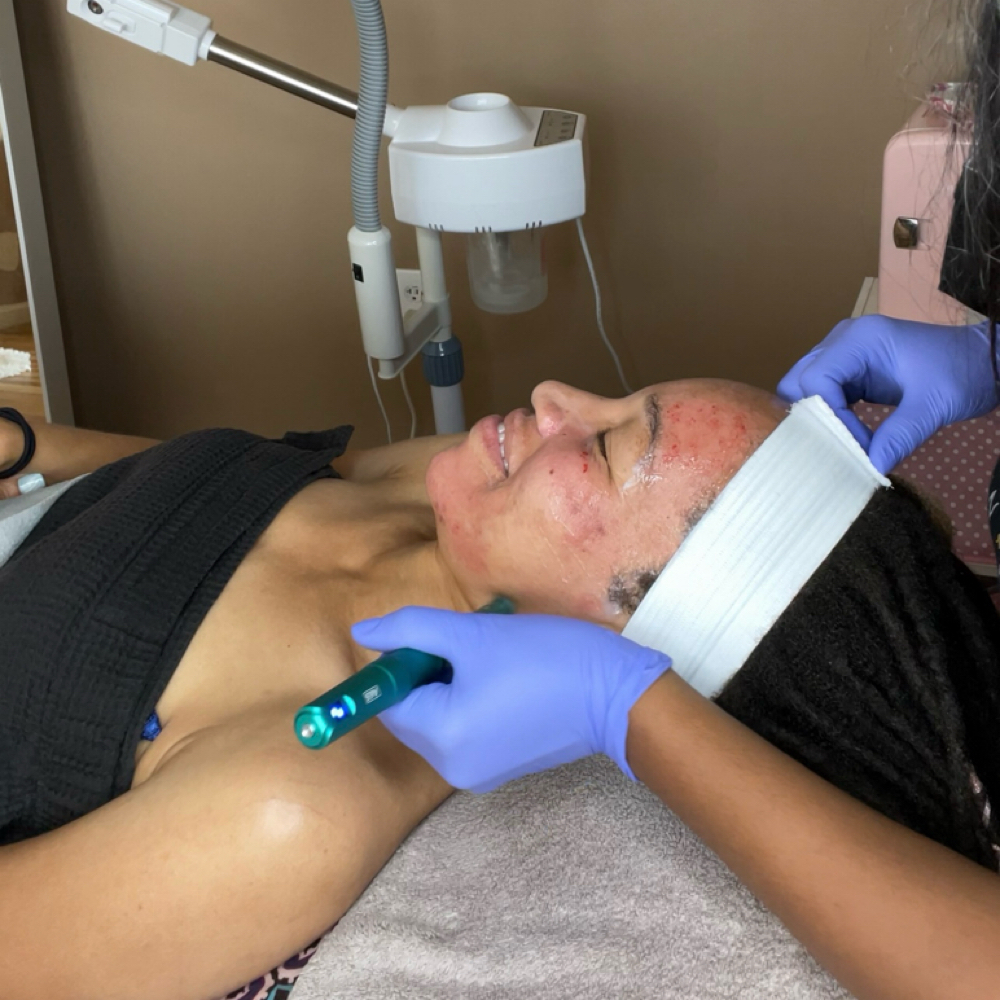Microneedling at Capital Complexion in Washington, DC