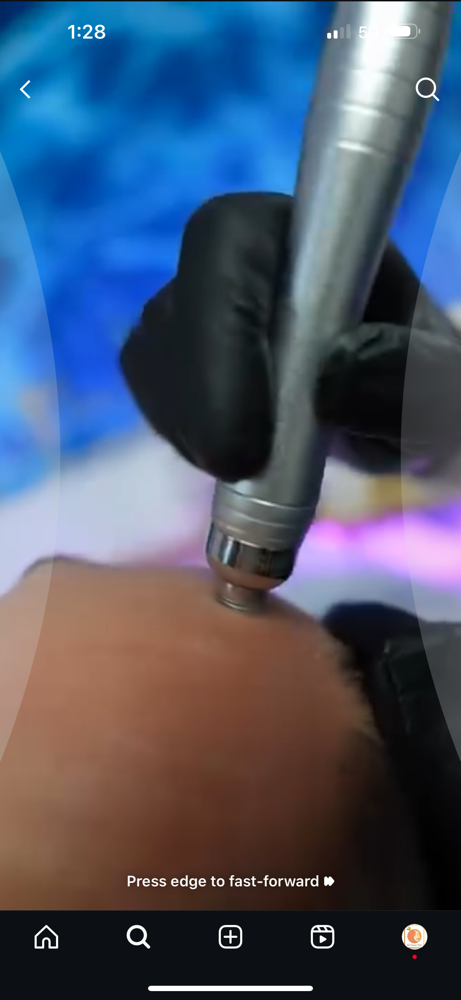 Microdermabrasion -Coming Soon