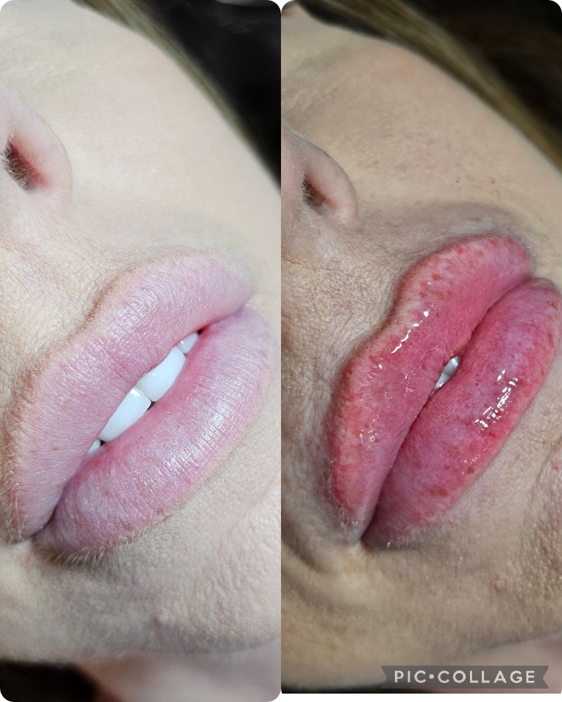 Lip Filler