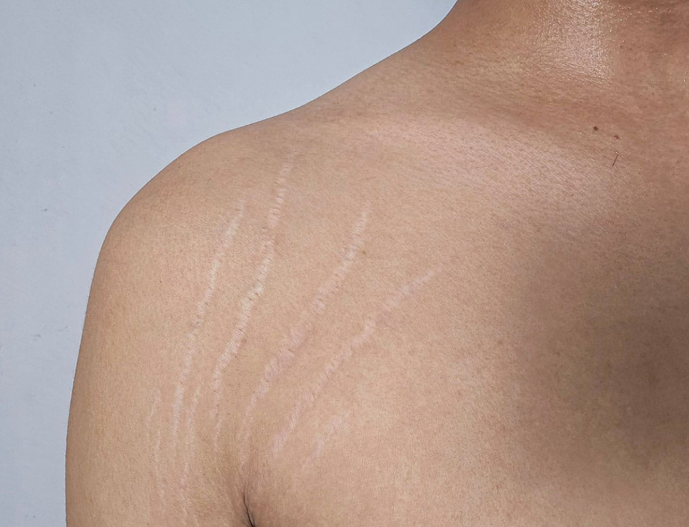 Shoulder/Armpit Stretchmark Camo