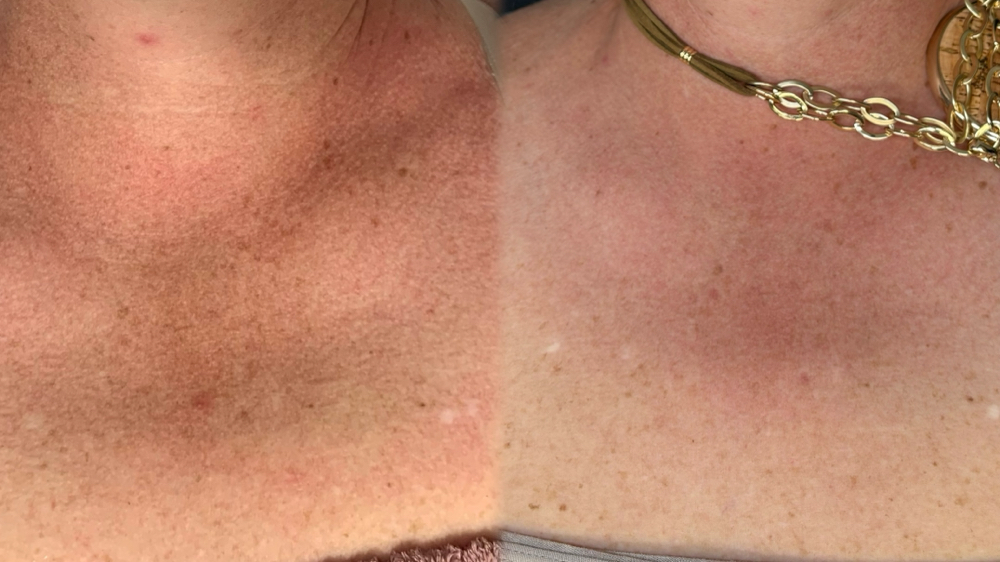 TCA Chemical Peel