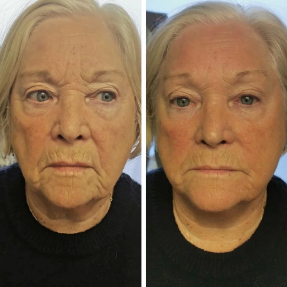 Hyaluronic Acid Filler at Josephs Rejuvenation Center in Snellville, GA