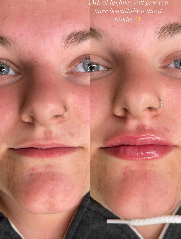 Needle Free Filler (1ML) at Holy Beauty Co in Kennewick, WA