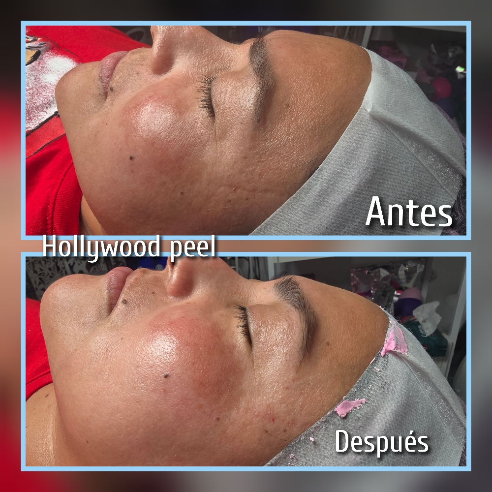 Limpieza Profunda Y Hollywood Peel