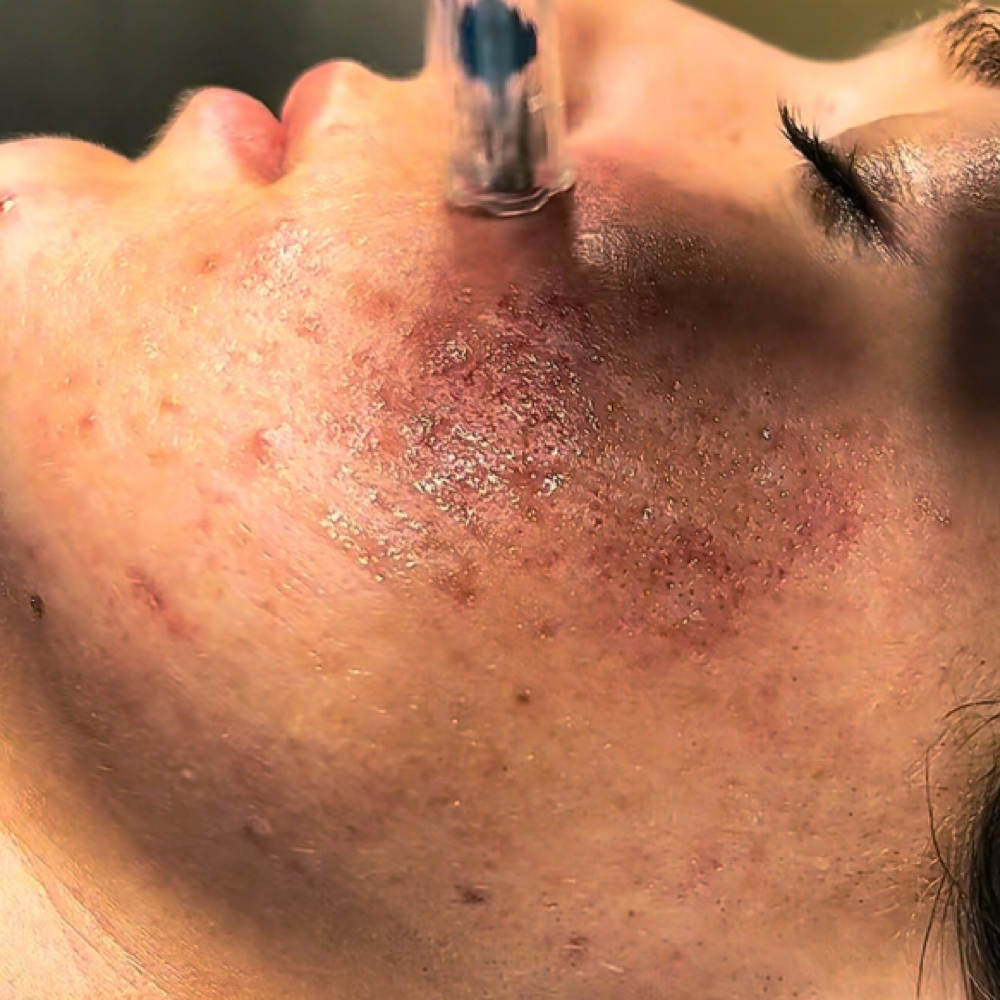 Microneedling at Radiant Glow Esthetics in Baker City, OR