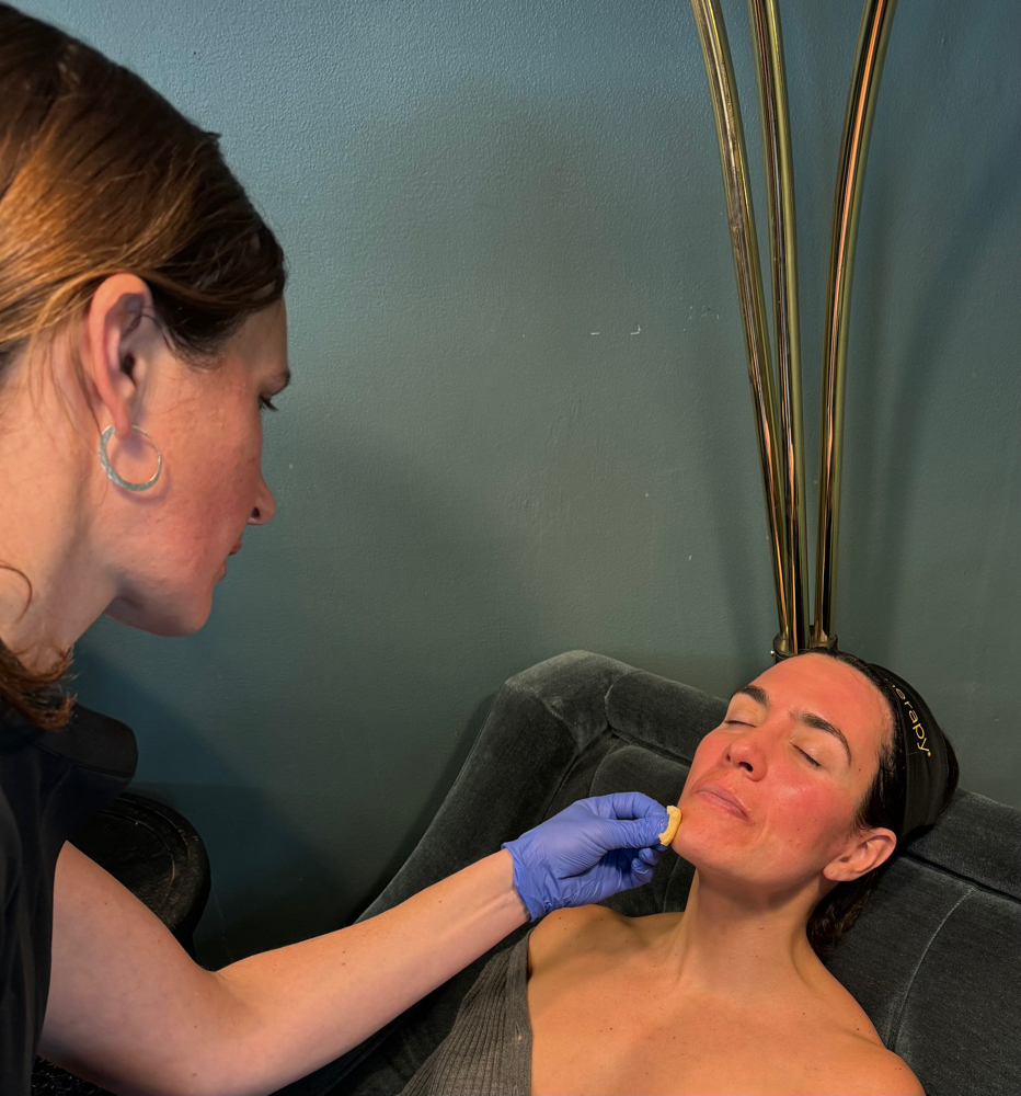 Chemical peel