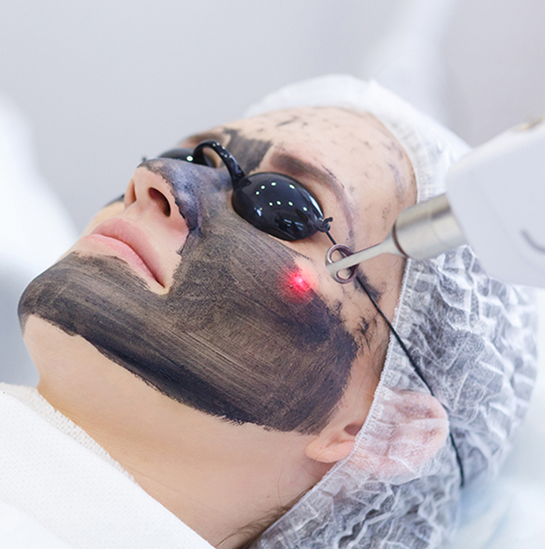 Hollywood Carbon Laser Facial at Glam Lab in Rancho Cucamonga, CA