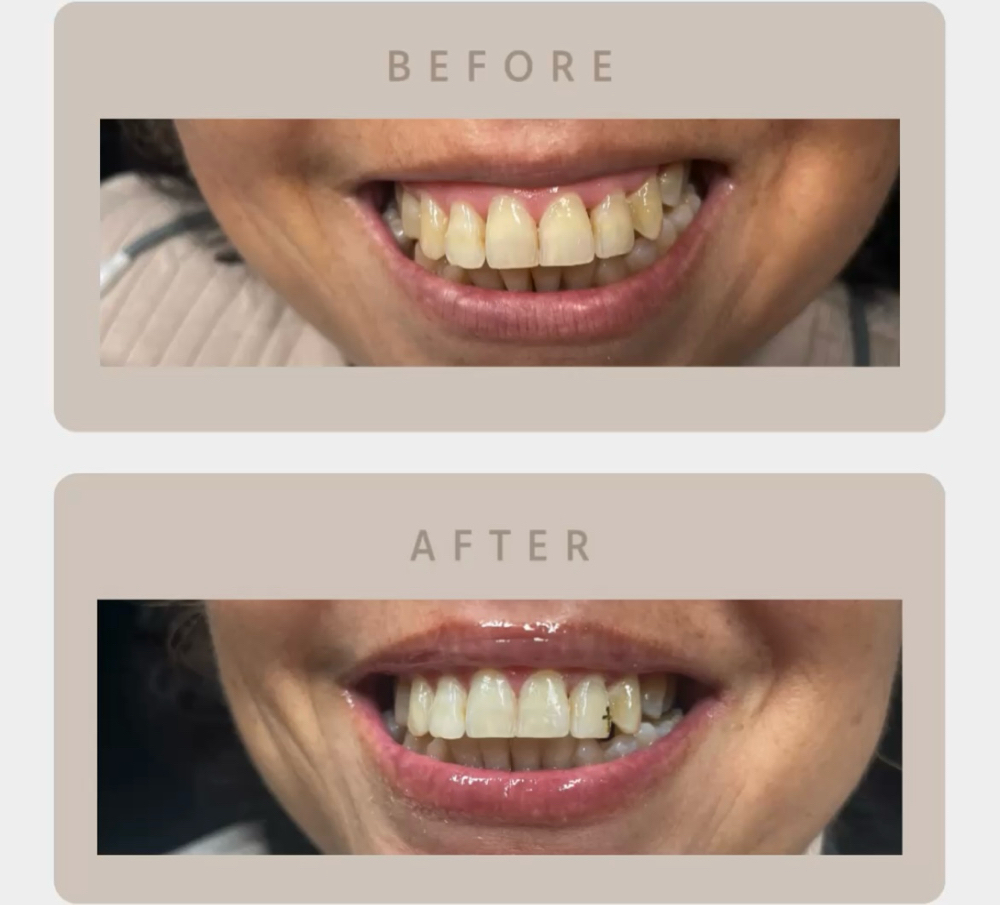 Blanqueamiento Dental at BELLALOTOMH  beauty lash studio in Beltsville, MD