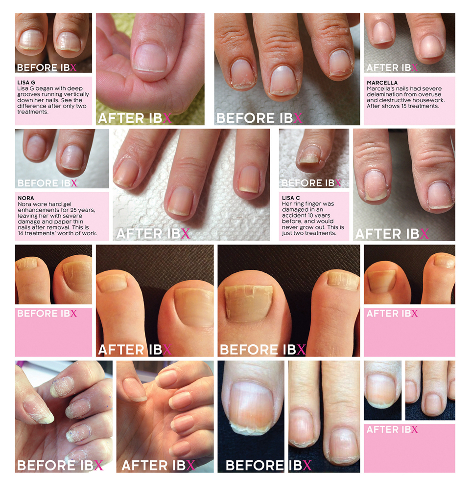 IBX Repair Treatment