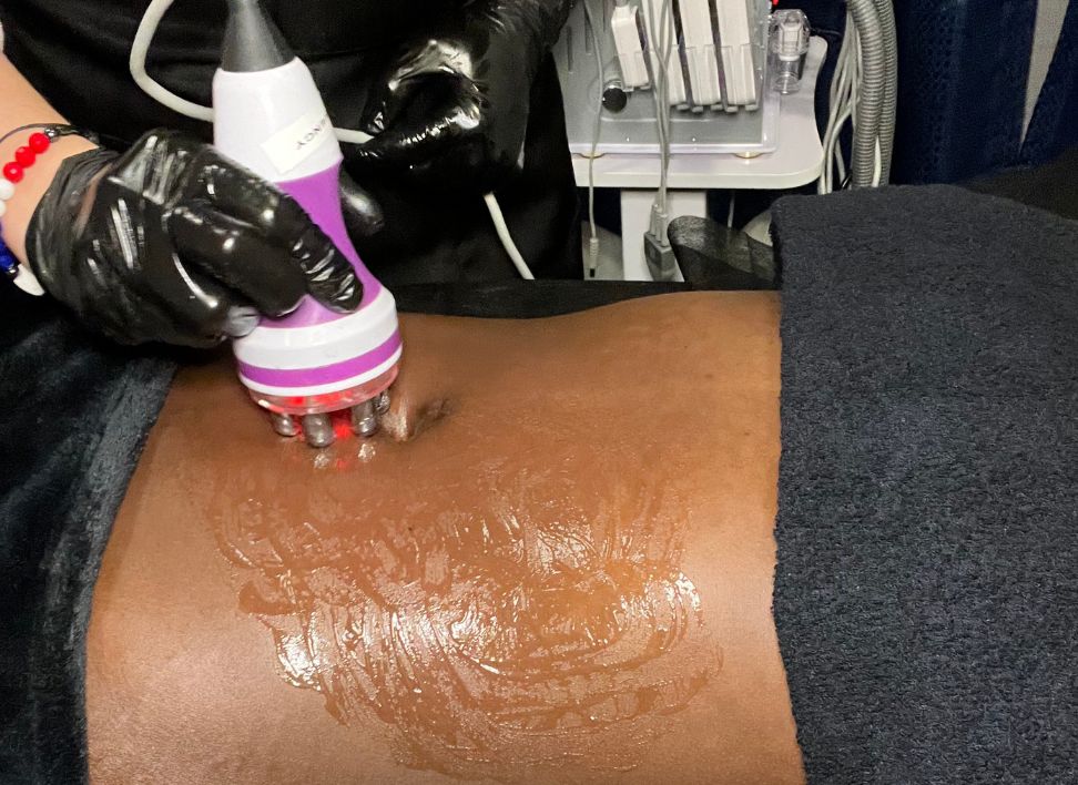 Radio Freq (RF) Skin Tightening