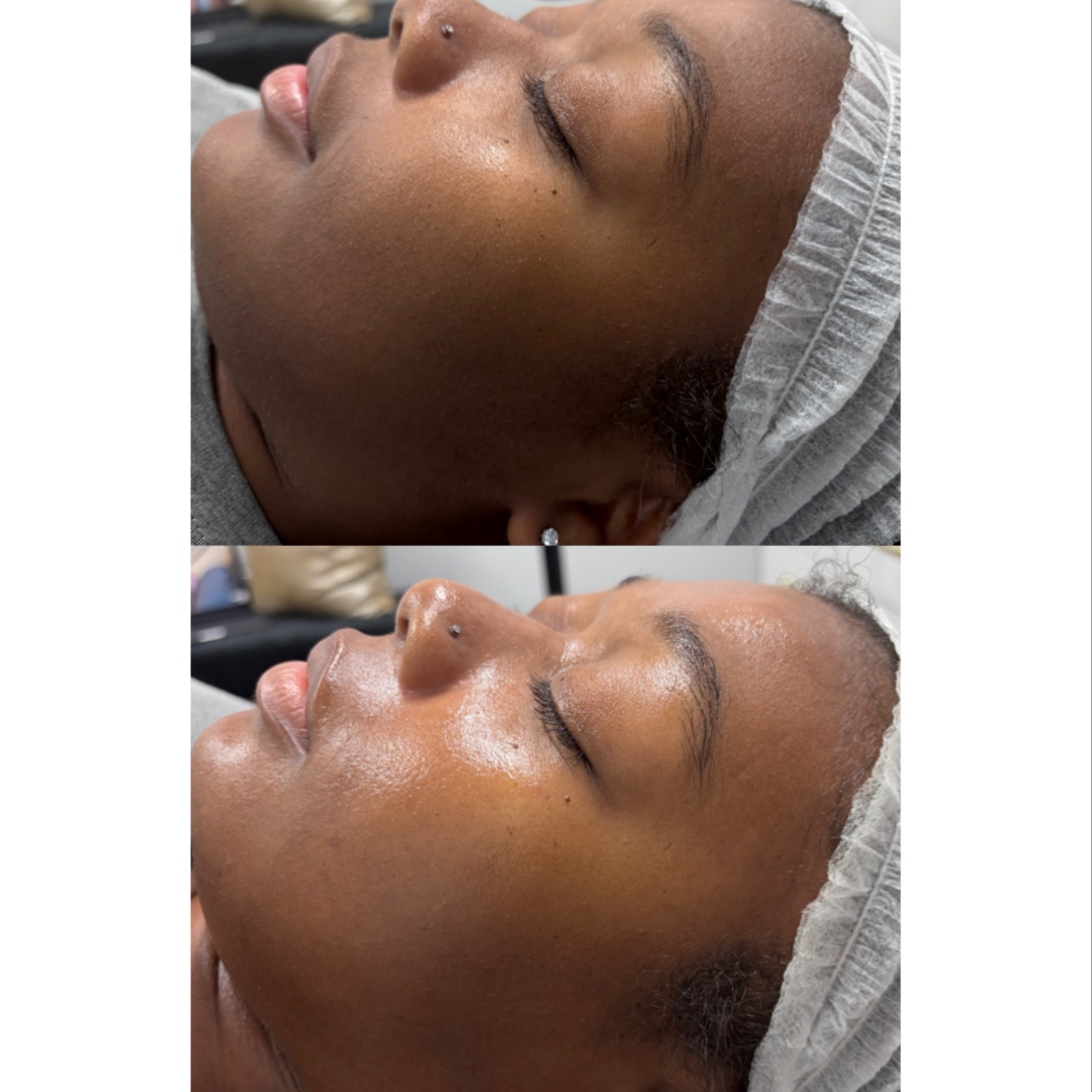 DERMAPLANE FACIAL at FIRMÉ SKIN in Columbia, MD