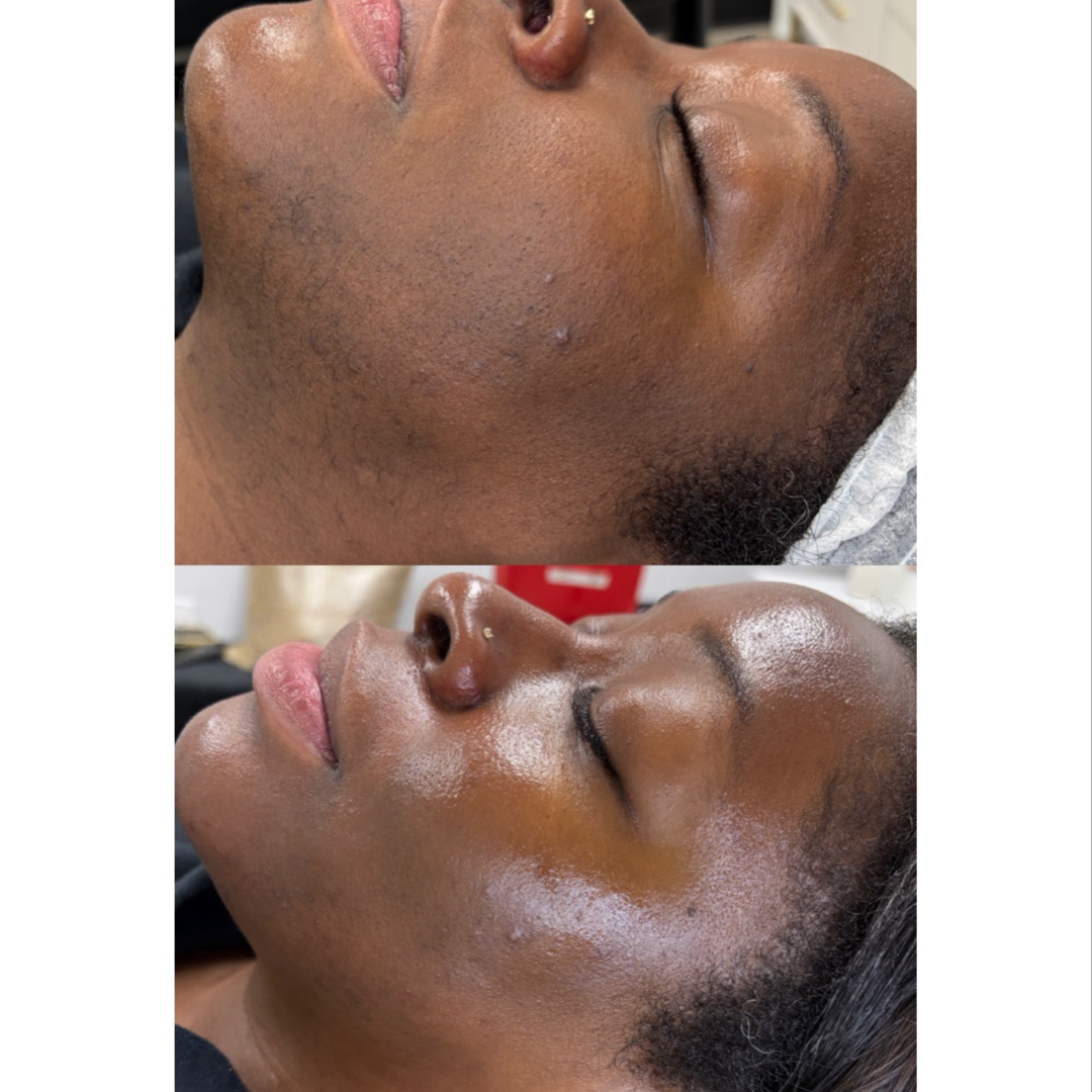 DERMAPLANE FACIAL at FIRMÉ SKIN in Columbia, MD