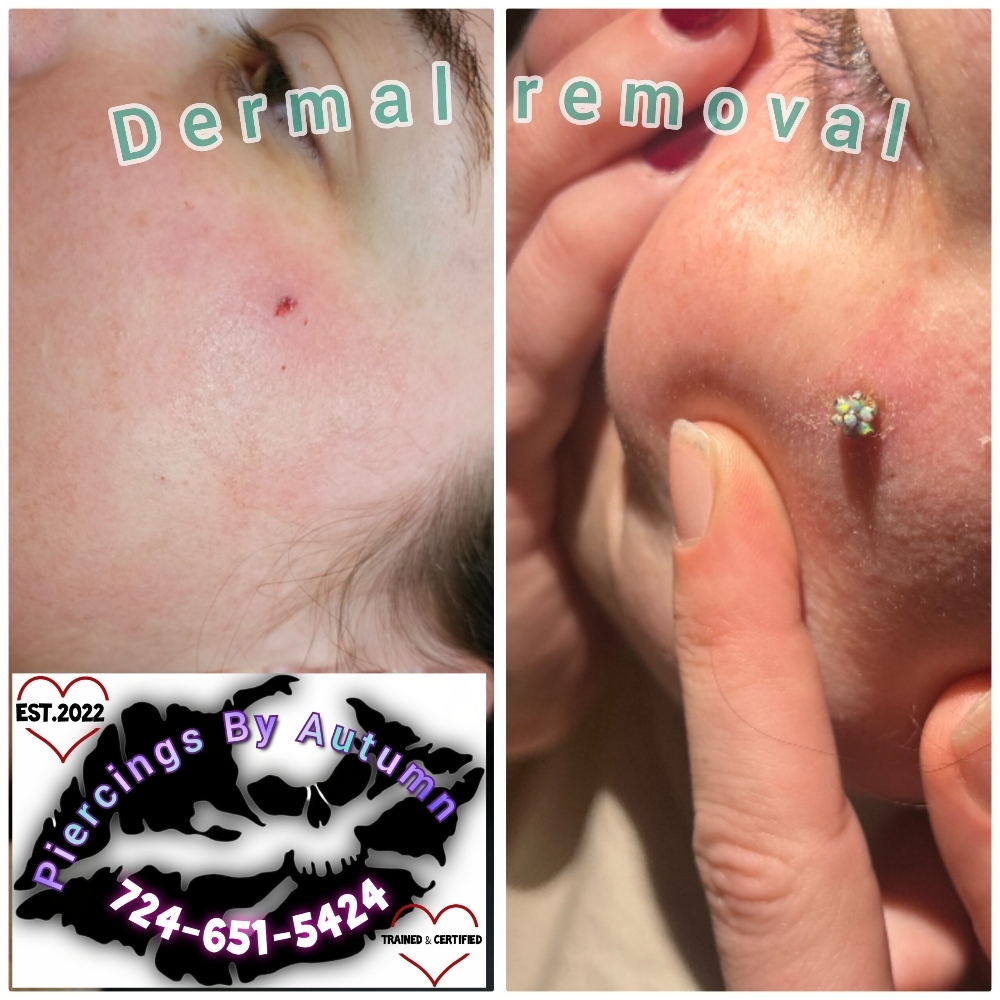 Dermal Removal at Piercings By Autumn in New Castle, PA
