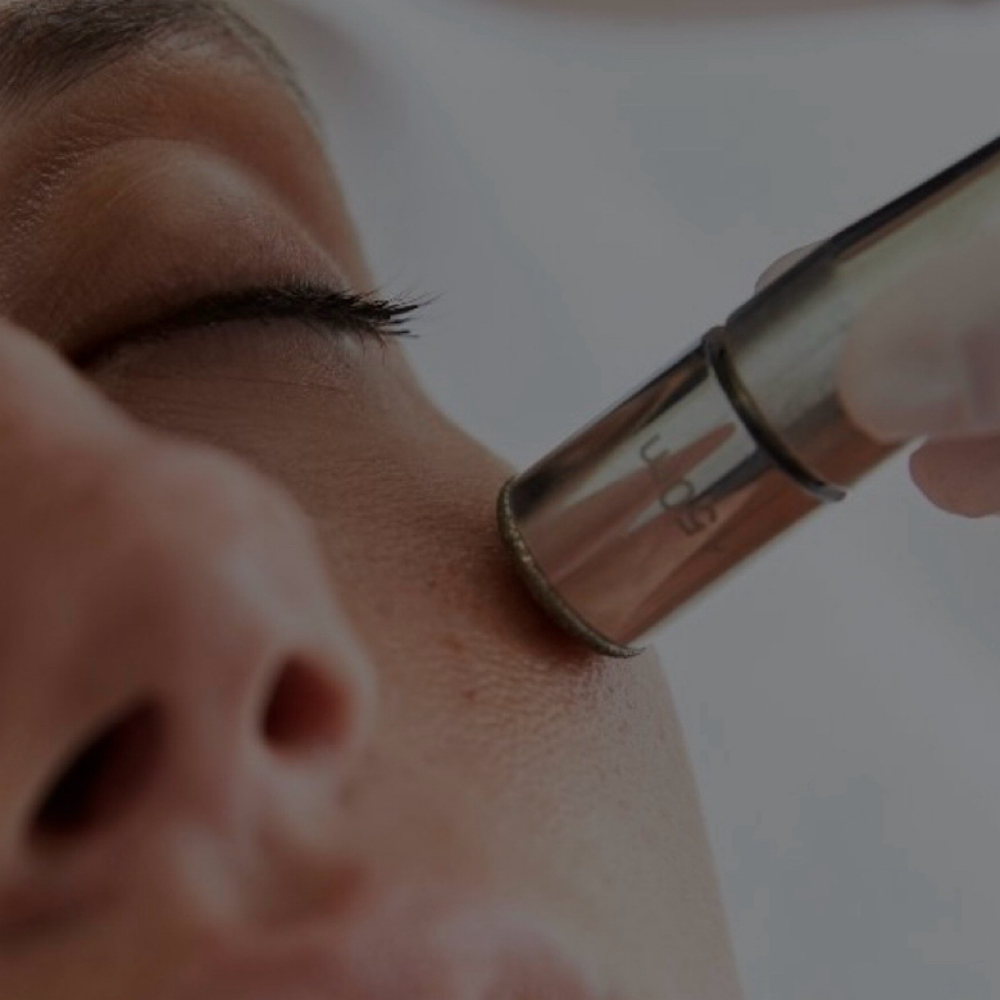 Diamond Microdermabrasion