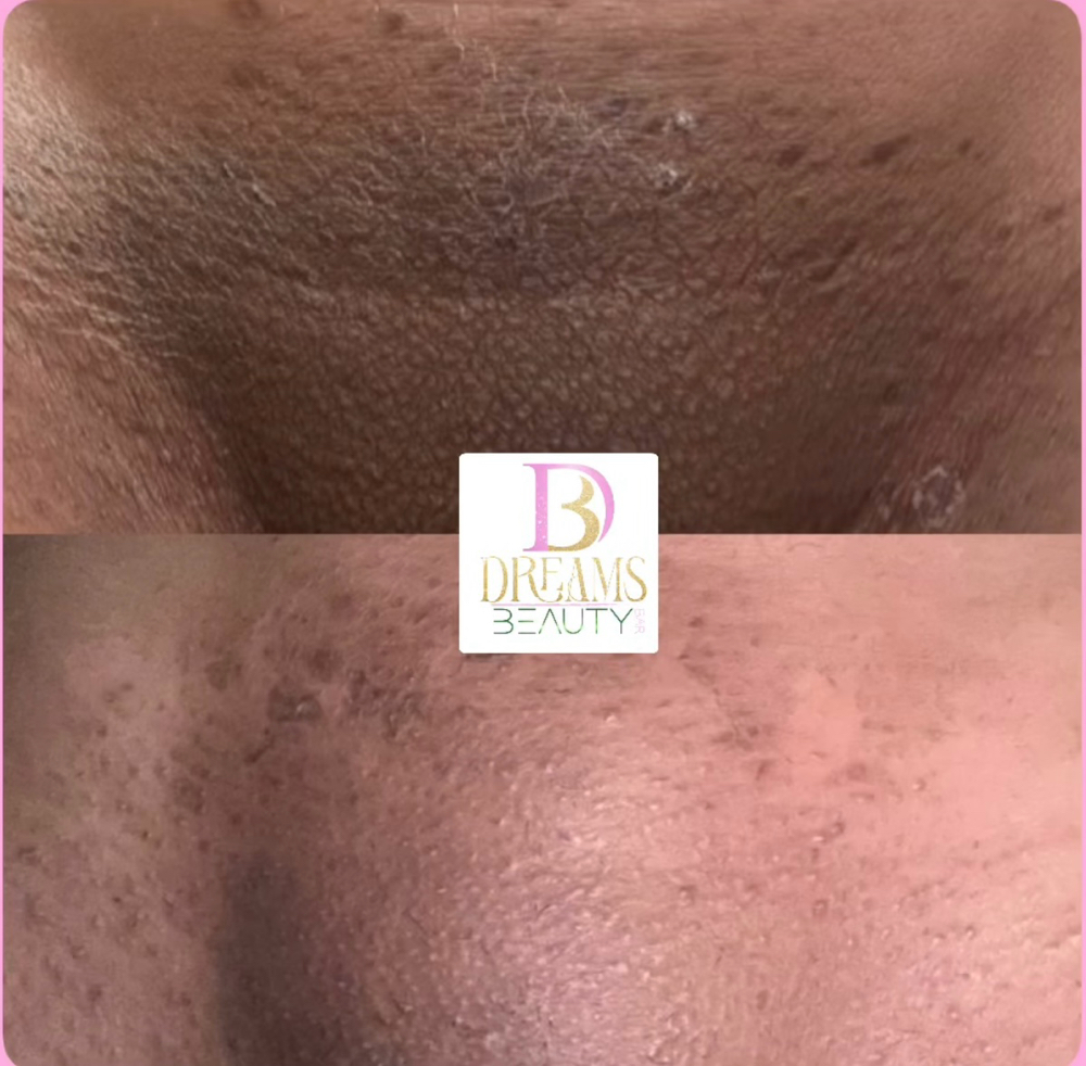 Vag/Bikini Area (IntimateBleaching)