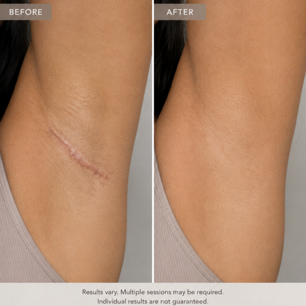 Underarm Scar Camouflage at Restored Hue Paramedical Studio in Atlanta, GA