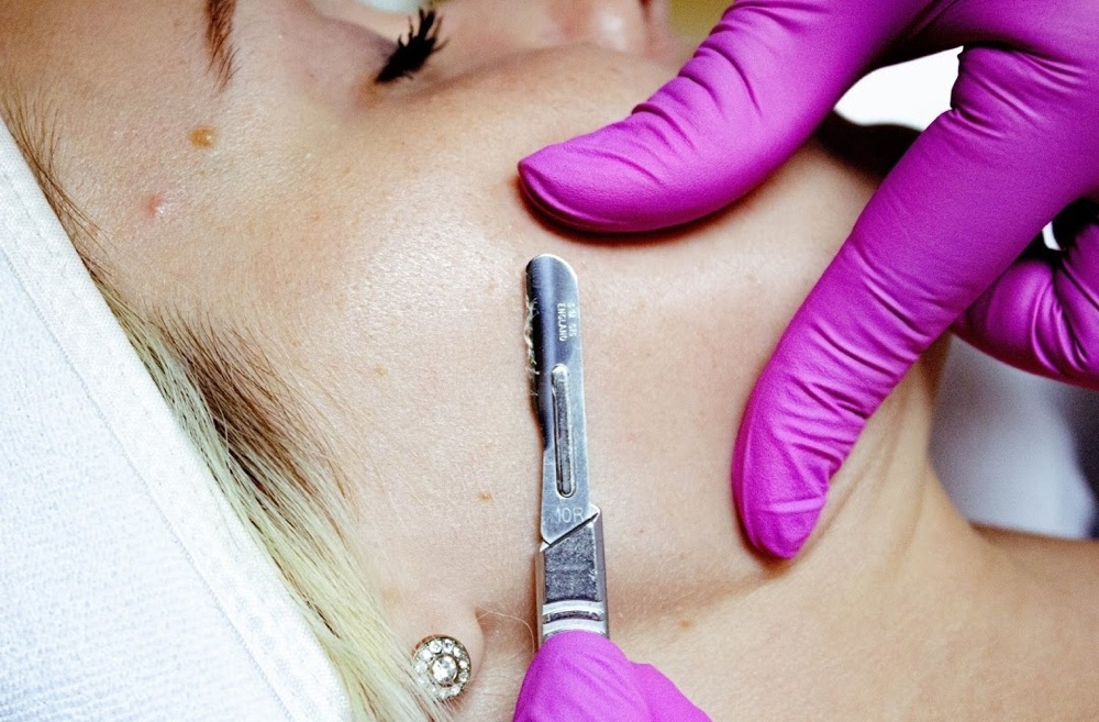 Dermaplaning