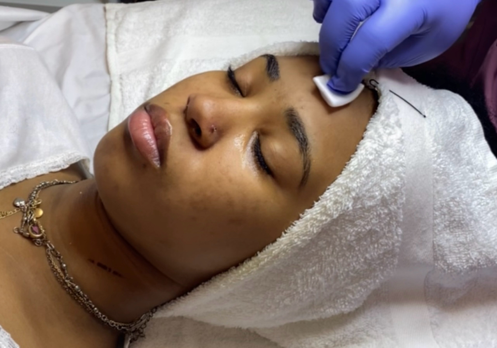 Medium Depth Peel at Sonder Skin in Newport News, VA