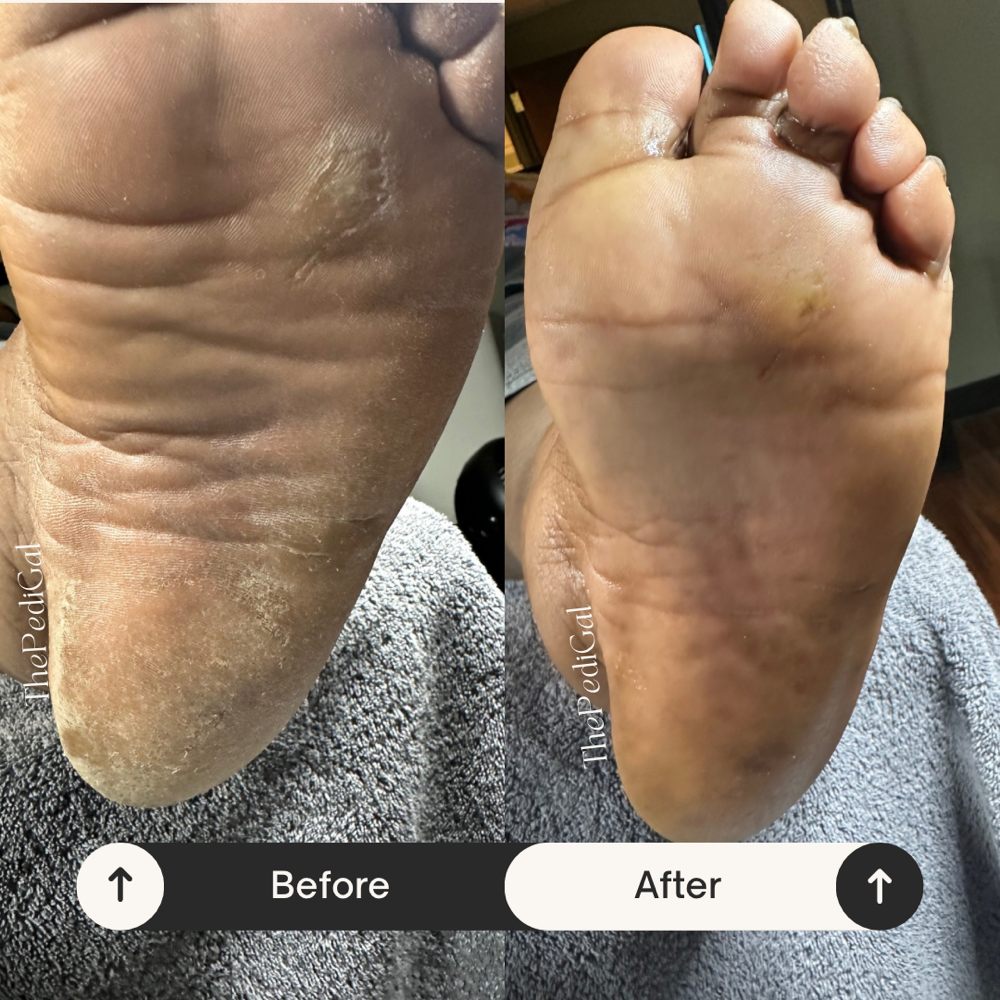 Callus Reduction