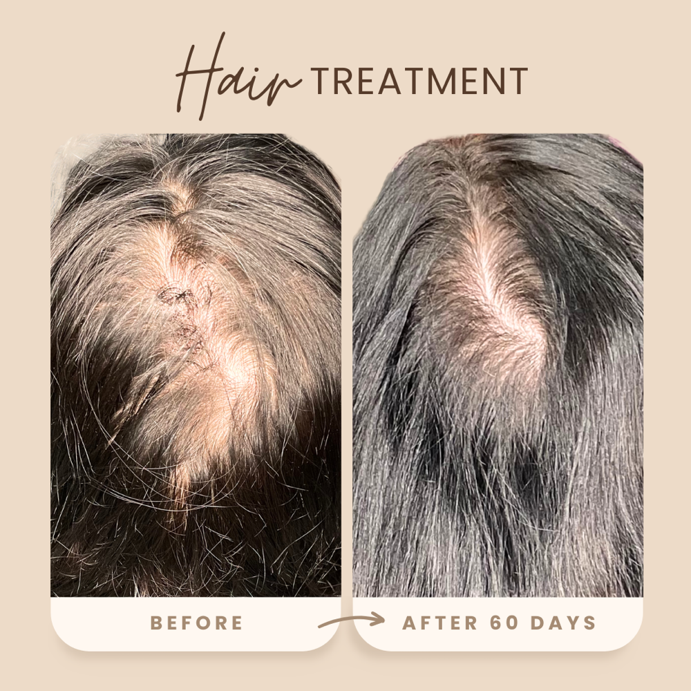 Crown Renewal Hair Restoration