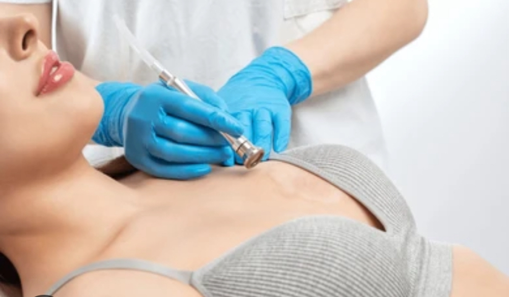 chest dermabrasion Treatment