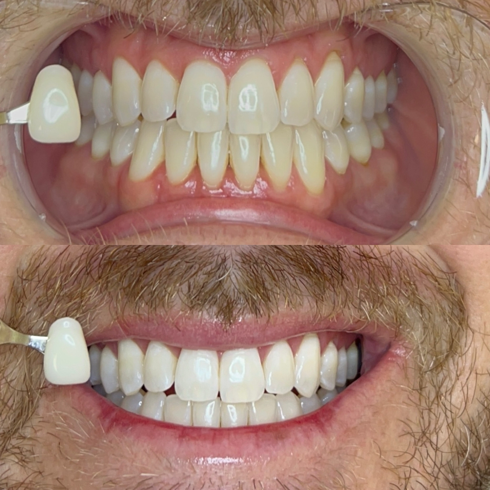1 HR Teeth Whitening Treatment at Fairywhite Teeth Whitening in Artesia, CA