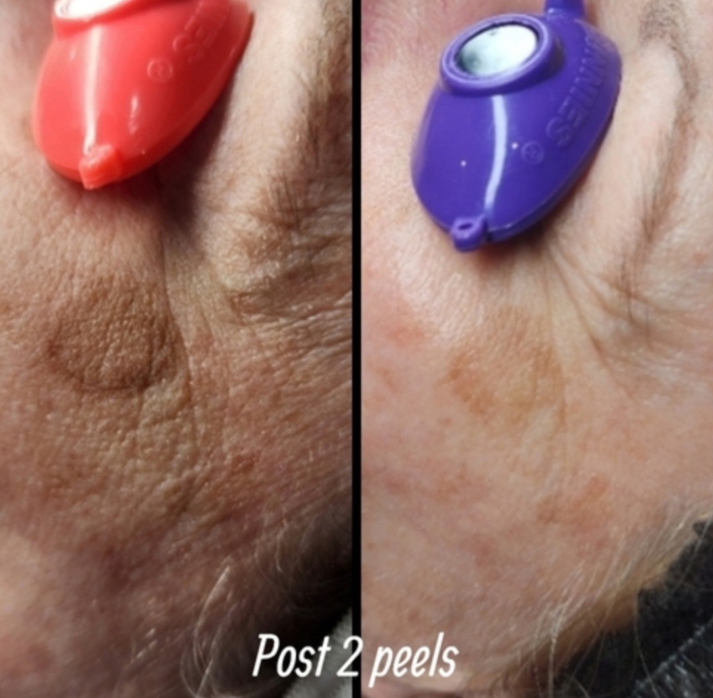 Chemical Peel 2- Advanced Peel