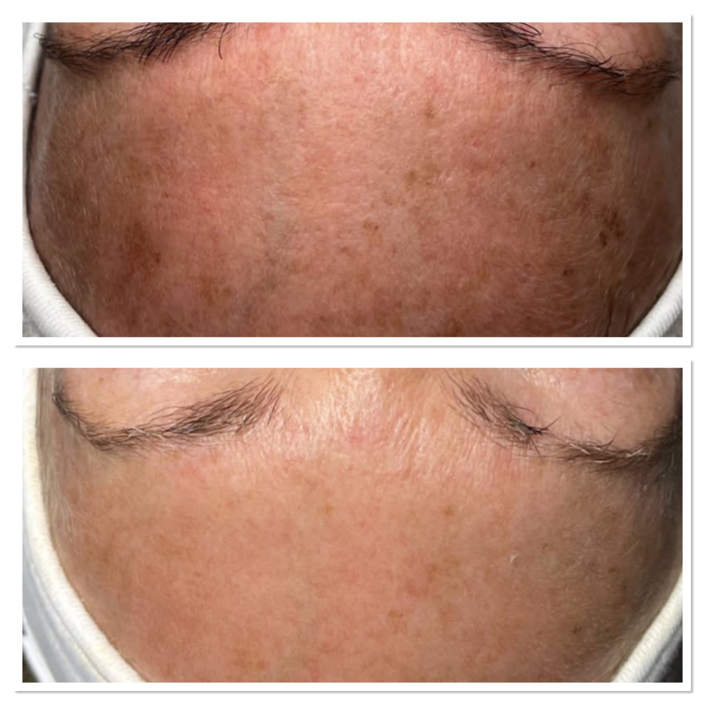 IPL Treatment Full Face