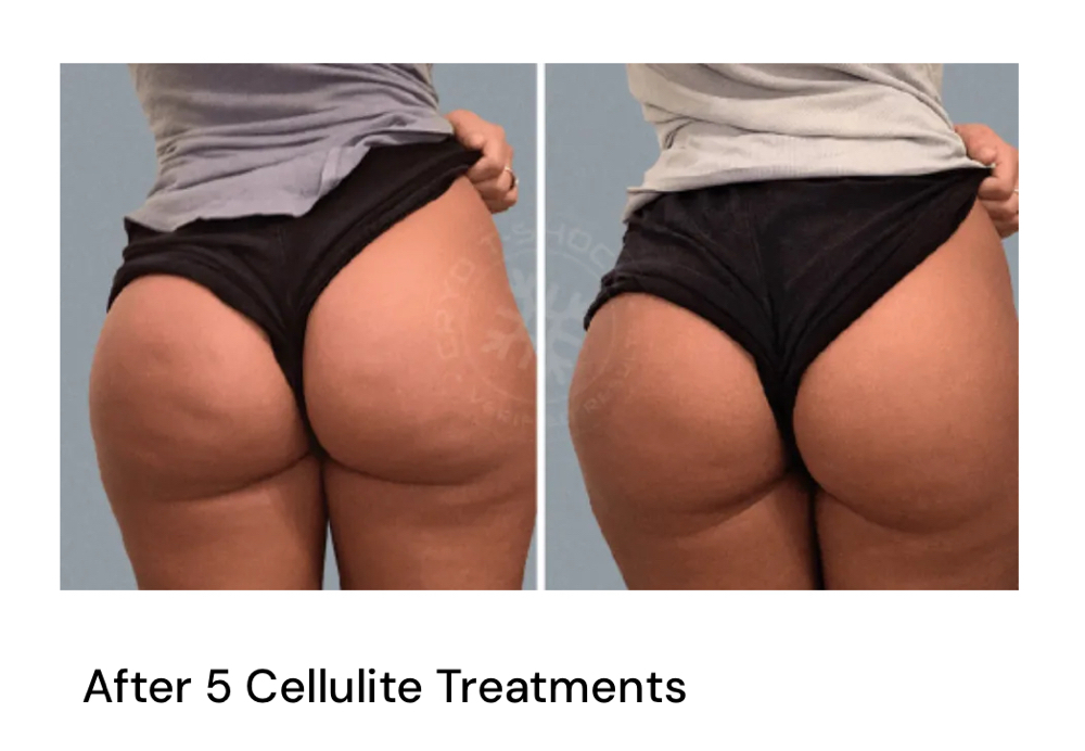 Cellulite Reduction-Legs Or Buttock at Lush Cryo and Wellness in Reno, NV