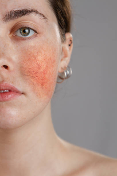 MoveoVL: Redness Reduction