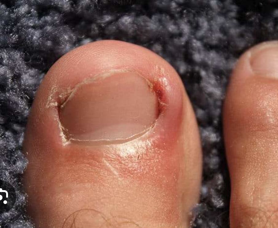 Ingrown Toenail Treatment (1 Nail)