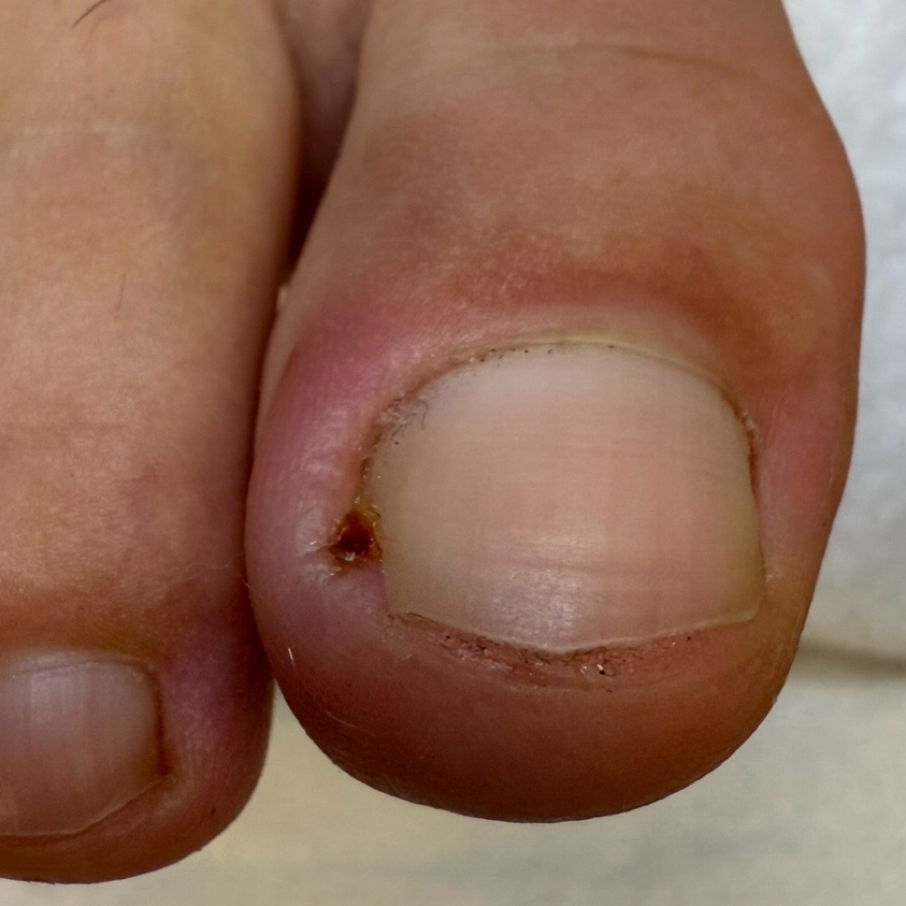 Ingrown Toenail  Treatment (1 Nail) at Teas Podocenter in Ardmore, PA