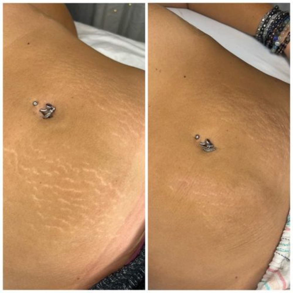 Microchanneling Body Treatment