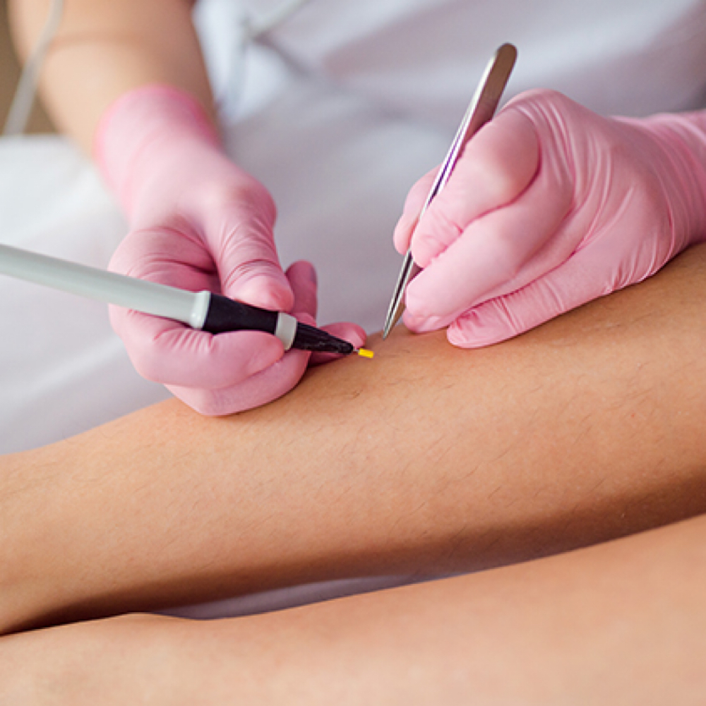 Electrolysis (Thermolysis) at Mirabella Beauty & Spa in Sarasota, FL