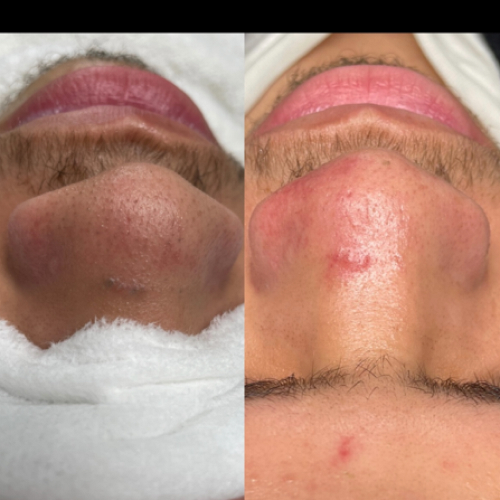 Acne Facial at Perla’s Nails in Orlando, FL